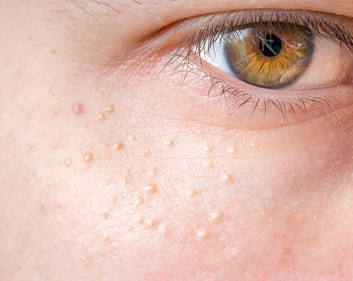 Dermatology