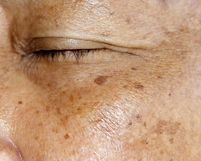Dermatology