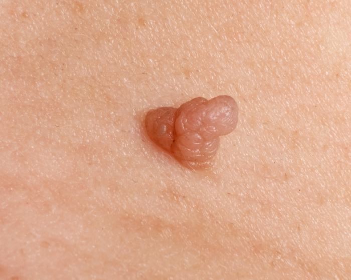 Dermatology